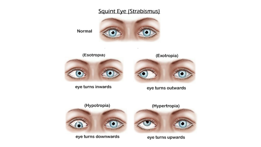 Paediatric Ophthalmology & Squint