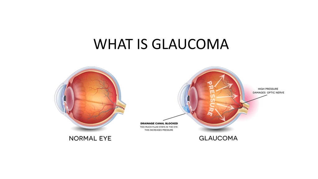 Glaucoma