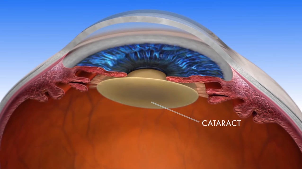 Cataract